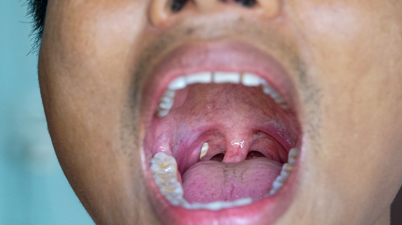 Practical Ways to Get Rid of Tonsil Stones at Home in 2025: Discover Effective Solutions