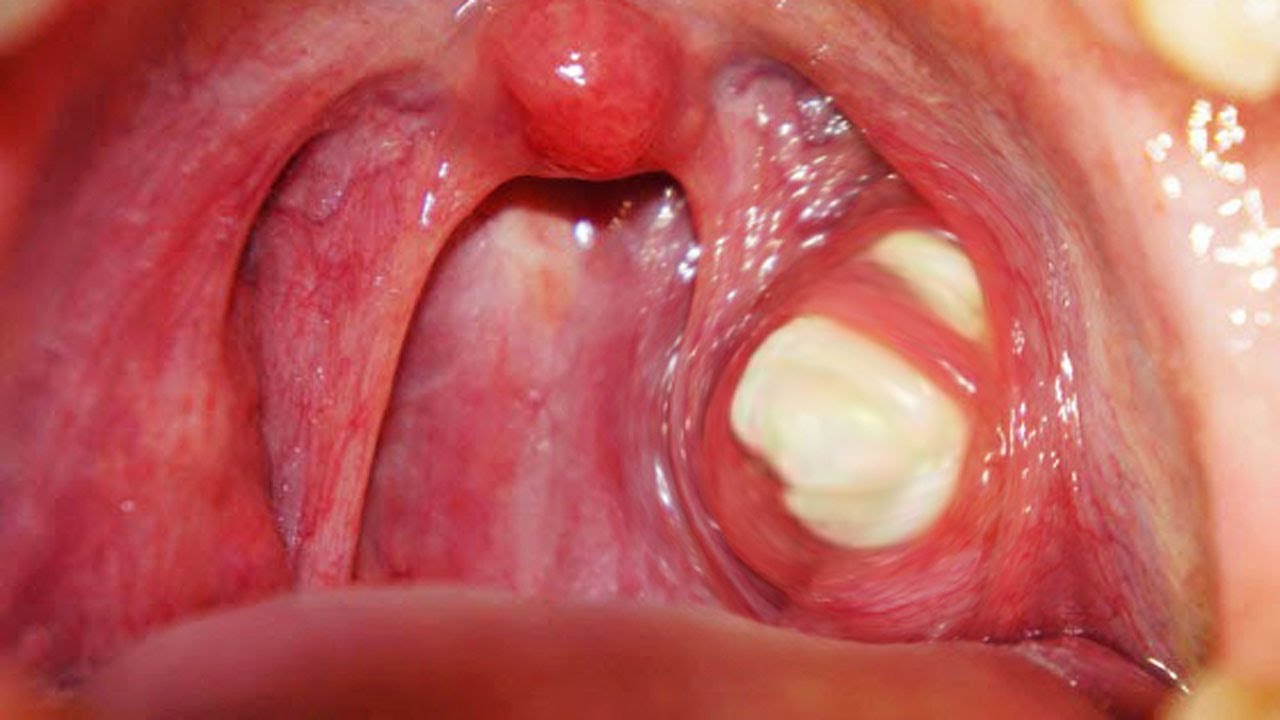 Tonsil stones home remedies